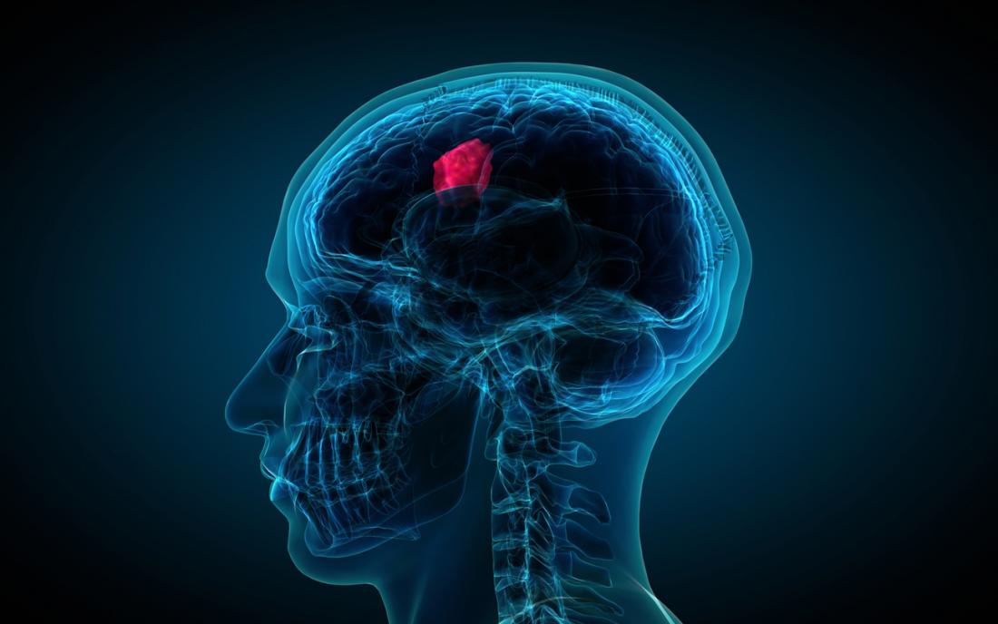 Tumores cerebrales y rehabilitación de los déficits cognitivos