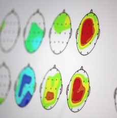 ¿Para qué es útil el Mapeo Cerebral?