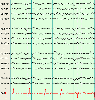 Resultado de imagen de mu rhythm in autism