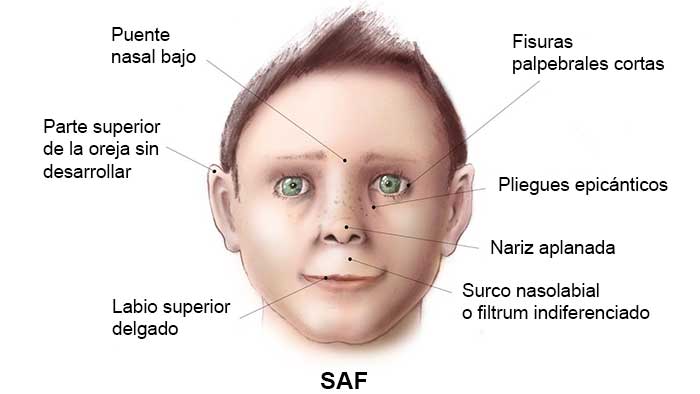 Síndrome alcohólico fetal: Alcohol en el cerebro del bebé - NeuroClass
